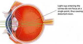 astigmatism- common eye conditions