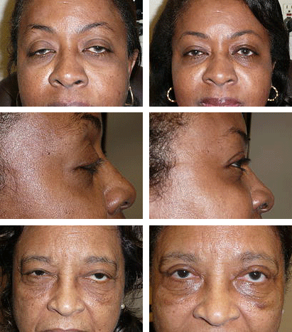 eyelid surgery droopy-eyelids-before-after