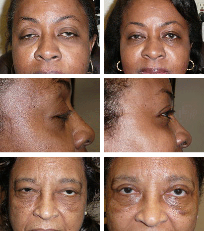 Eyelid surgery clearance