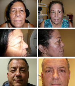 Blepharoplasty before and after 
