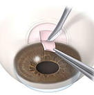 surgery- glaucoma treatment