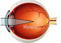 myopia- common eye conditions