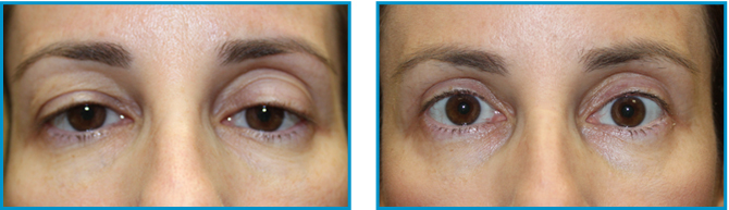 Eyelid procedure results before-after-001