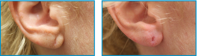 Ear lobe procedure results before-after-002