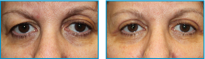 eyelid procedure results before-after-003