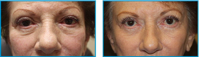 Cosmetic procedure results before-after-004