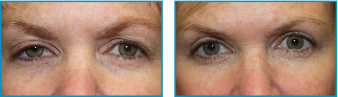 Eyelid procedure results before-after-005