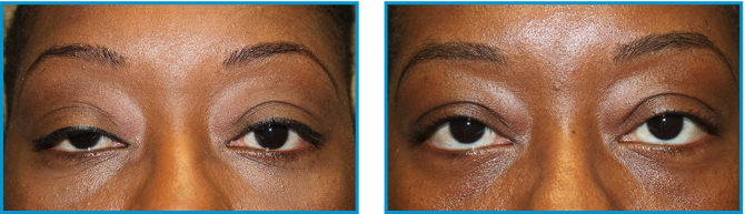 Eyelid procedure results before-after-006