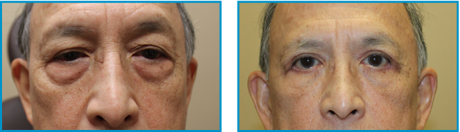Eyelid procedure results before-after-007