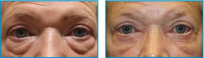 Eyelid procedure results before-after-008