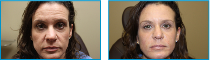 Cosmetic procedure results before-after-009