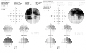 Humphrey Visual Field (10-2) Testing demonstrates a paracentral scotoma which is consistent with this macular toxicity that occurs with Plaquenil: