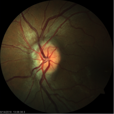 Case of the Week | Pseudotumor Cerebri