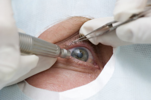 HollywoodEye.2.3.4.Advancements-in-Cataract-Surgery.